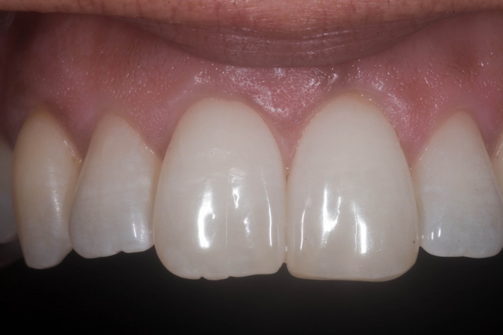 Can my crooked front teeth be straightened ? Blue Court